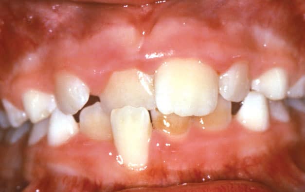 Crossbite Hunt Orthodontics in Muskegon, North Muskegon, and Fremont, MI