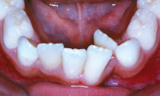 Crowding Hunt Orthodontics in Muskegon, North Muskegon, and Fremont, MI