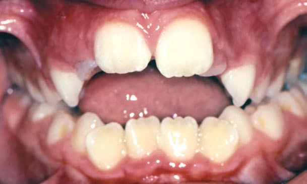 Open Bite Hunt Orthodontics in Muskegon, North Muskegon, and Fremont, MI