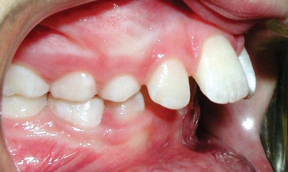 Protrusion Hunt Orthodontics in Muskegon, North Muskegon, and Fremont, MI