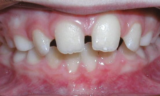 Spacing Hunt Orthodontics in Muskegon, North Muskegon, and Fremont, MI